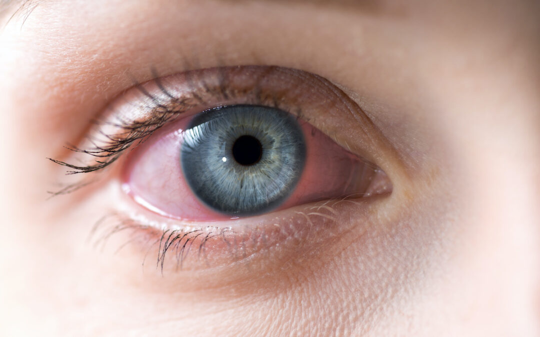 Conjunctivitis